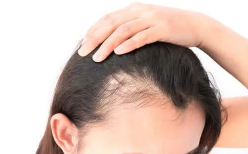 Alopecia bij vrouwen en psychologische gevolgen