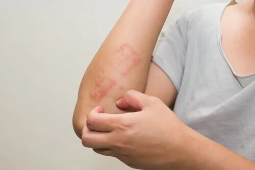 Atopiskais dermatīts, 6 padomi tā ārstēšanai