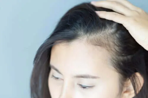 Alopecia bij vrouwen en psychologische gevolgen