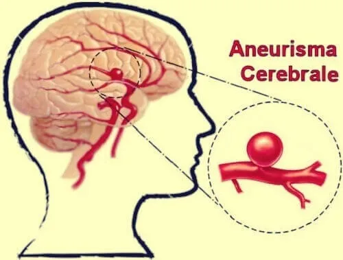 Церебрална аневризма: определение, симптоми, лечение